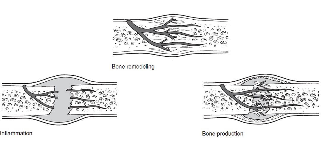 BONE HEALING